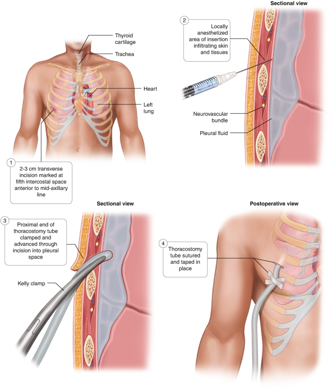 Chest Tube Insertion