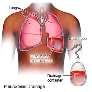 Chemical Pleurodesis