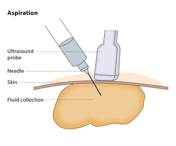 Needle Aspiration