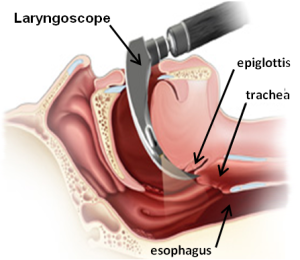 Endotracheal Intubation